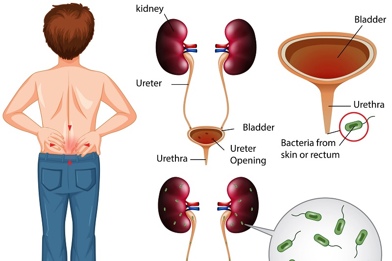 precio-de-la-valoracion-de-infeccion-de-vias-urinarias-recurrentes